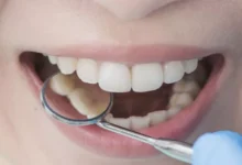 زراعة الأسنان-الحل الحديث لابتسامة مثالية ووظائف فم صحية